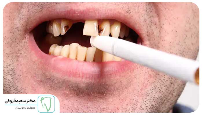 عوارض سیگار برای ارتودنسی