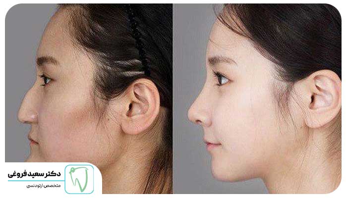 ارتودنسی چگونه روی فک تاثیر می گذارد؟