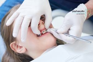 انواع ارتودنسی ثابت