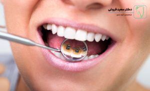 ارتودنسی لینگوال