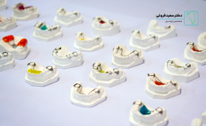 انواع نگهدارنده بعد از ارتودنسی