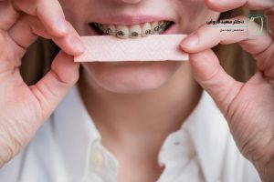 آیا ارتودنسی باعث آسیب به دندان میشود؟ فروغی