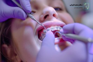 ارتودنسی برای عقب بردن فک