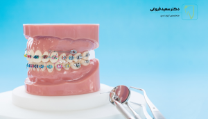 انواع رنگ اورینگهای ارتودنسی فروغی