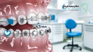 کدام نوع ارتودنسی بهتر است؟ فروغی