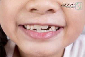 ارتودنسی برای دندان خرگوشی؛ بررسی کامل درمان و نکات کاربردی فروغی